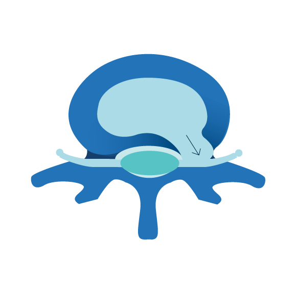NUCLEUS PULPOSUS